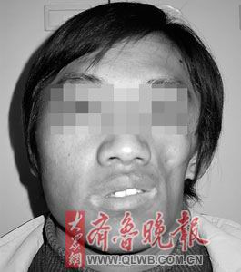 22岁青年面部萎缩 取下背部肉再造左脸庞(组图