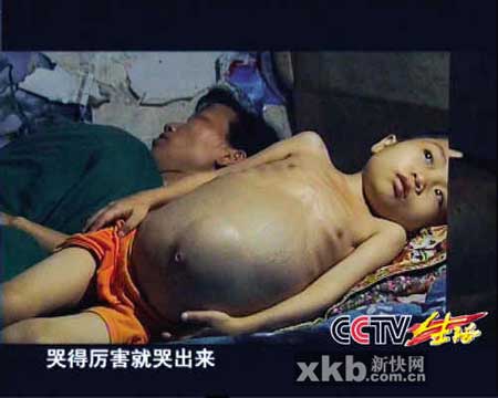 女孩患地中海贫血症+7年吃掉8万个烟头(图)