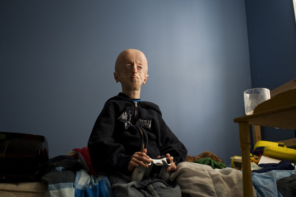 16岁早衰男孩如60岁老人