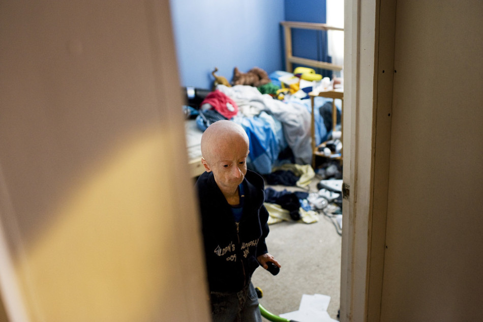 16岁早衰男孩如60岁老人