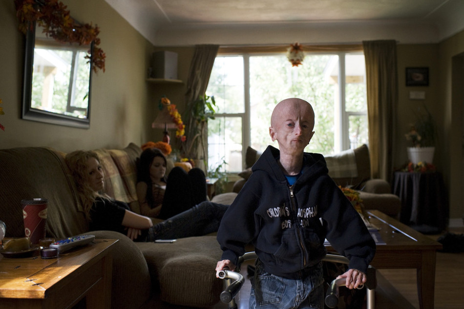 16岁早衰男孩如60岁老人