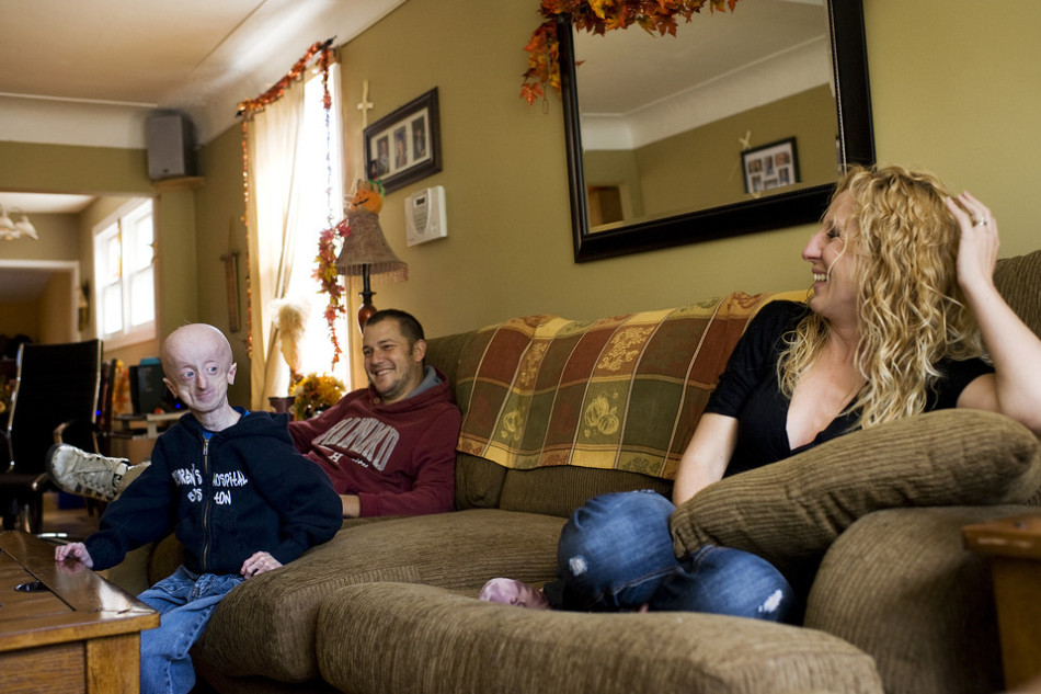 16岁早衰男孩如60岁老人