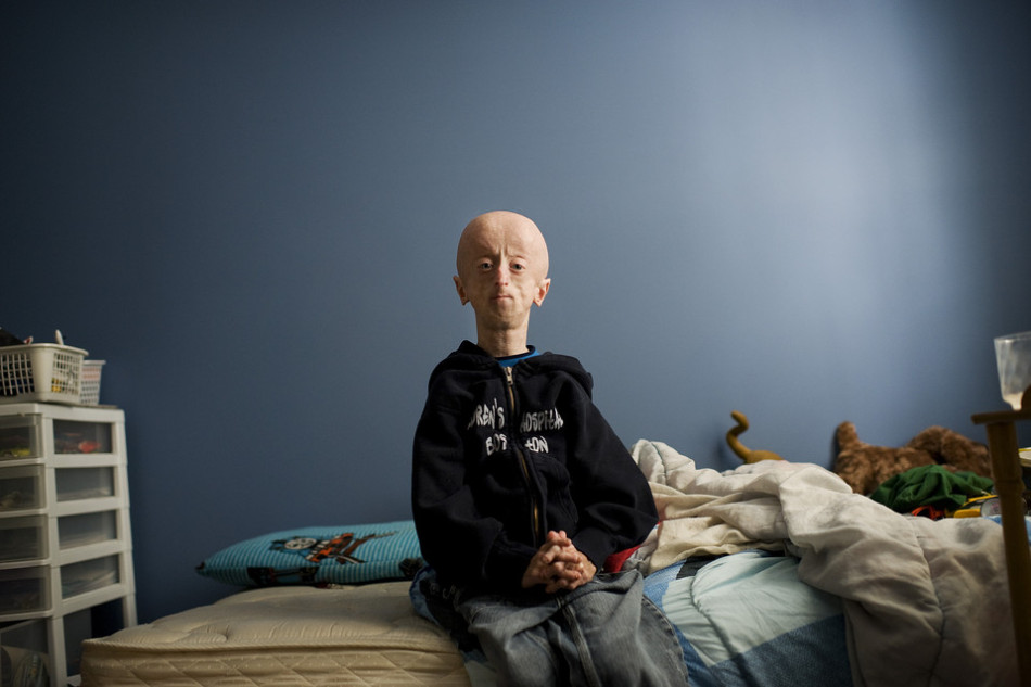 16岁早衰男孩如60岁老人