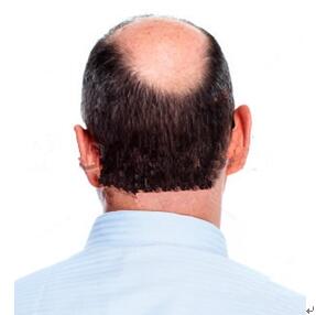 头顶头发掉是什么原因解答男性头顶头发稀少怎么办 - 青岛新闻网