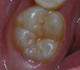 窝沟封闭:小朋友牙齿的保护衣 -青青岛社区