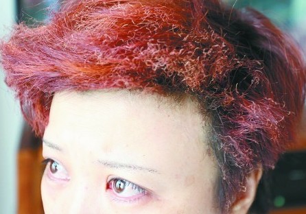 张女士的头发、眉毛被烧。