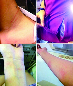 空姐“花Money买毛豆”微博上贴出照片显示，其身上有伤痕、衣服被扯破。