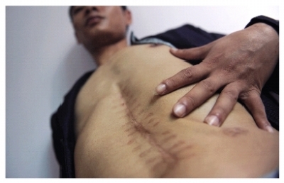 9月24日，湖南岳阳，刘勇手术后“少了一个肾脏”，腹部留下了长长的伤疤。