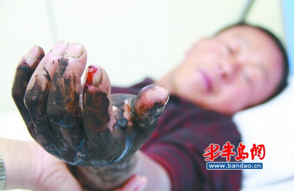 邹先生的左手被蛇咬伤后明显肿胀。