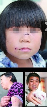 6岁女童上学路上遭疯狗啃脸 20人合力打死恶狗