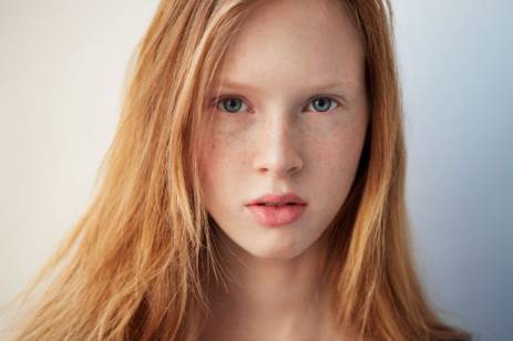 怎么去脸上色斑简单有效 一星期除雀斑小偏方