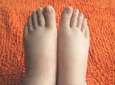 脚是身体的晴雨表,有这些变化一定得小心了,