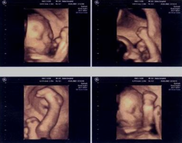 医院因孕妇太胖拒做B超?脂肪厚度会影响观察 医院因孕妇太胖拒做B超?脂肪厚度会影响观察