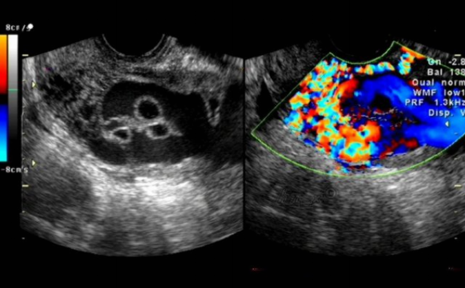 医院因孕妇太胖拒做B超?脂肪厚度会影响观察 医院因孕妇太胖拒做B超?脂肪厚度会影响观察
