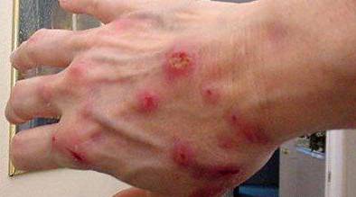 夏天这种虫子能留在人的皮肤内!有草的地方就有它!