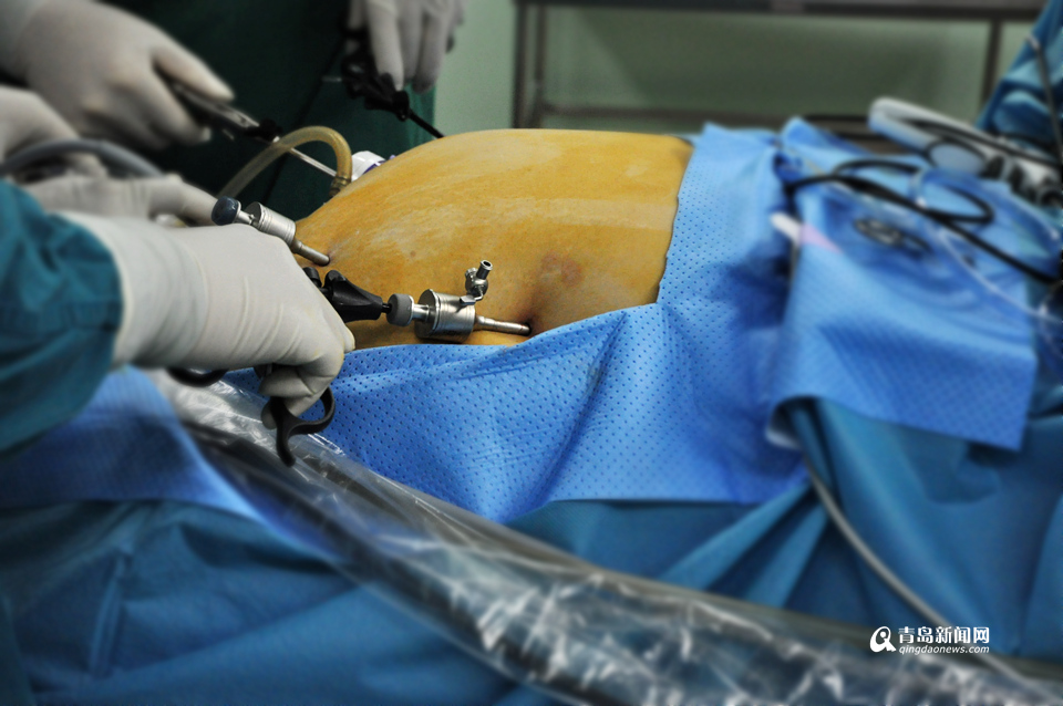 手术减肥200斤只流5ml血 权威就在青岛家门口