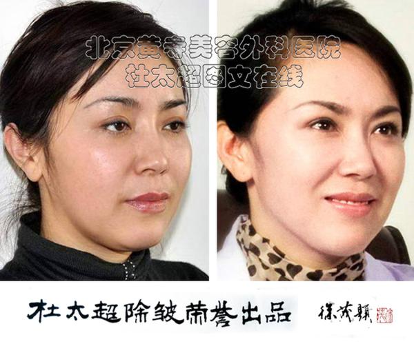 算一笔经济账,快快逃离面部年轻化非手术美容陷阱