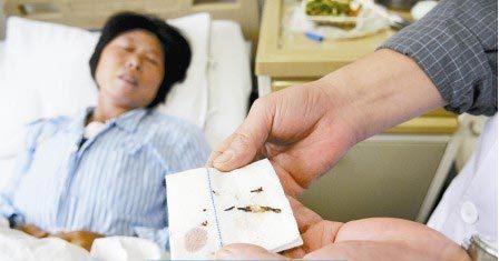通过手术取出的针。　　商报记者 