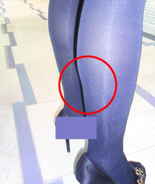 青岛女子小腿抽脂后变形变更粗 美容中心:年后再看