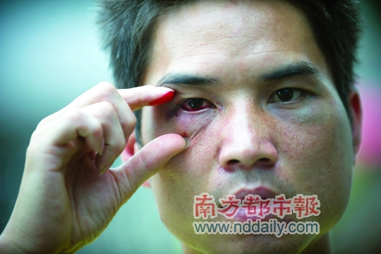 皮某身上多处被打伤。