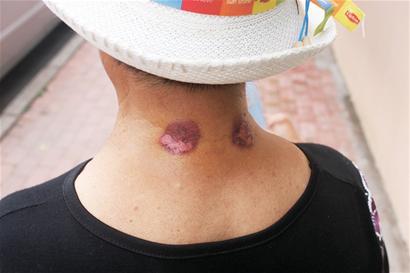 三伏贴专贴任督二脉 青岛女子钻心刺痒起水泡