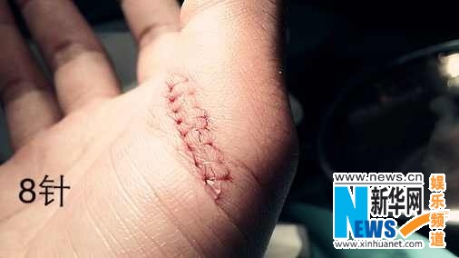 乐嘉录影摔伤右手缝八针