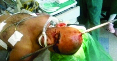 铁棒刺后脑从双眼穿出