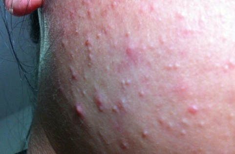 植秀堂3680元美容疗程换来一脸痘 店家称排毒