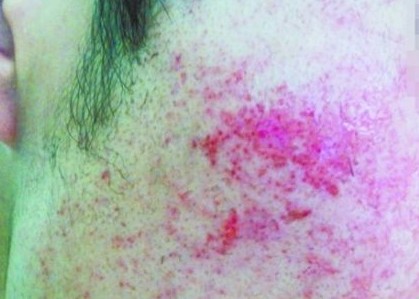 屈臣氏购薇婷脱毛膏致面部过敏 布满红疙瘩