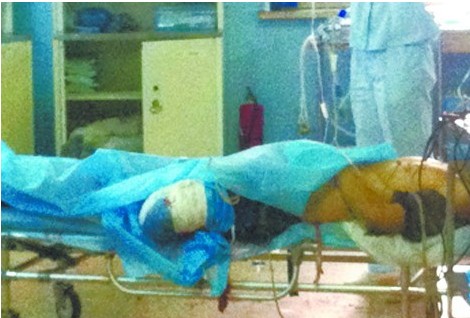 小伙左大腿被轧断只剩一截 血染纱布痛苦嚎叫