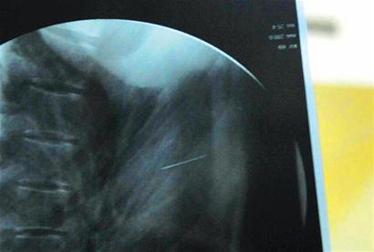 15岁少女缝衣针蹊跷扎进心脏 连续一年肚子疼