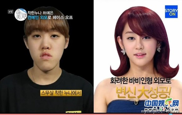 多图剧透韩国整容节目《LET 美人》近几期，最爱小V脸，人瘦就能美