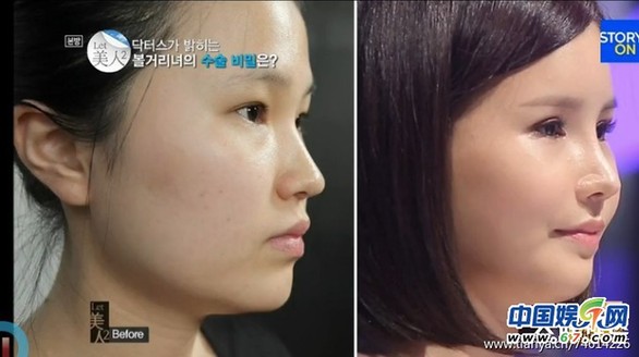 多图剧透韩国整容节目《LET 美人》近几期，最爱小V脸，人瘦就能美