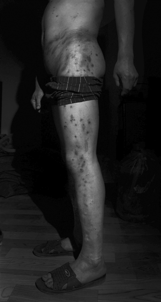 10月4日,湖北智障人士吴发兵腰部及腿部伤痕累累。他称,8月8日,他被骗到洗车行工作,多次遭领班殴打。