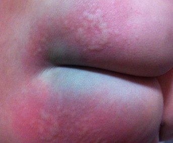 淘宝购花王纸尿裤致宝宝屁股过敏变紫红色