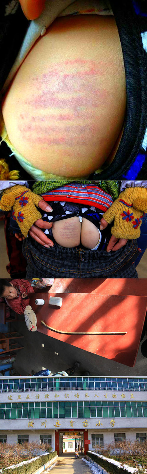学生挨打的痕迹至今清晰可见