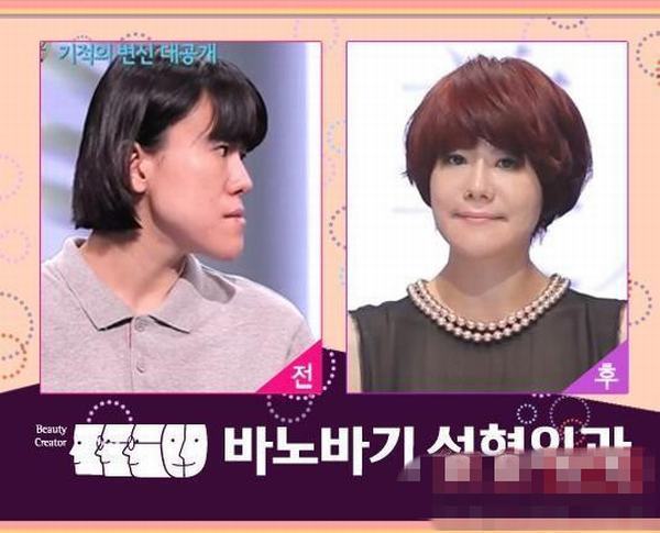 韩国《LET 美人2》整容节目前后对比惊人