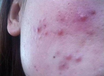 无极限产品用后满脸长痘 不负责被指传销