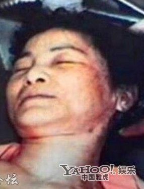 邓丽君尸检照曝光 疑似曾遭掌掴