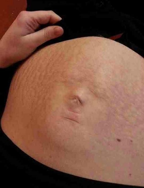 凯伦展示她肚子上的“脸”