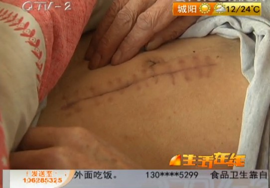 肠镜检查戳破老汉肠子 感染化脓挨一刀 肠镜检查戳破老汉肠子 感染化脓挨一刀