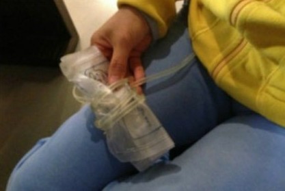 携尿袋乘客遭东航拒载 病情加重改乘南航