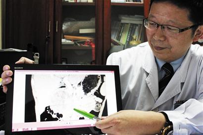 8岁女孩被同学两脚踢出血肿 1年后才知是肿瘤