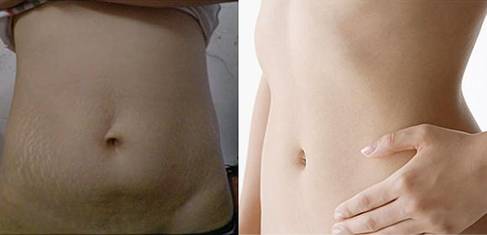 祛妊娠纹产品排行榜