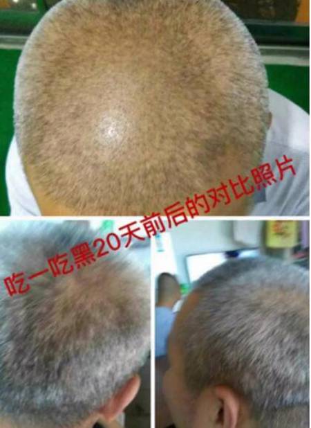 一吃黑效果怎么样?一吃黑白发变黑发?一吃黑到底有多好