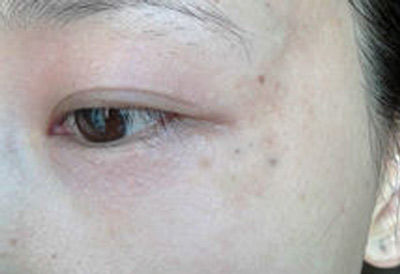眼角周围长了黄褐斑怎么办揭晓去除黄褐斑的最好方法