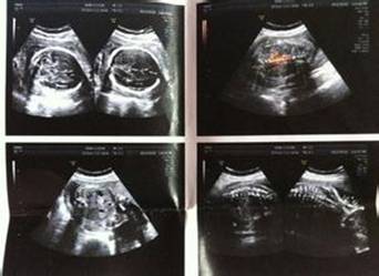 8周双胞胎b超单图片图片