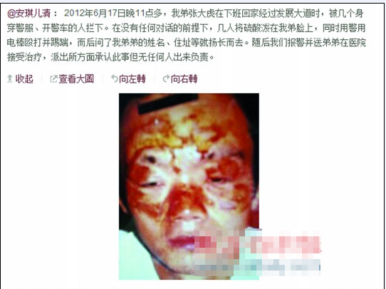 张大虎的姐姐将弟弟面部烧伤一事发上微博，引发网友广泛关注。