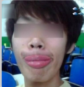 男子遭蝙蝠偷吻变香肠嘴